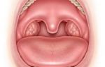 Причины, симптомы и лечение воспаления миндалин в горле