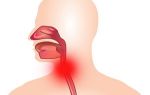 Воспаление гортани: причины, диагностика и лечение