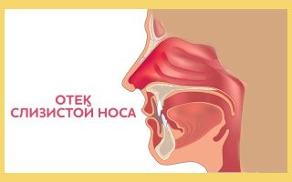 Чем вызван отек слизистой носа? Симптомы недуга