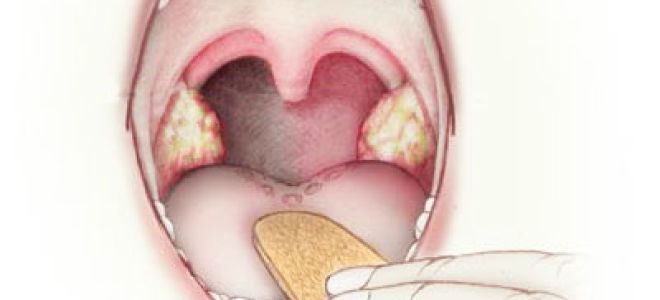 Симптомы и лечение хронического тонзиллита