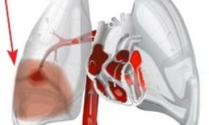 Инфаркт легкого: возникновение, признаки и лечение